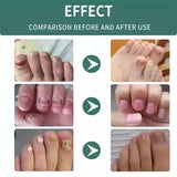 Nail & Foot Fungus Treatment Serum – Repair and Restore Healthy Nails