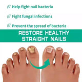 Nail & Foot Fungus Treatment Serum – Repair and Restore Healthy Nails
